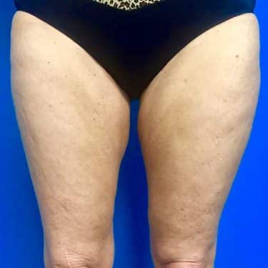 CoolSculpting 04 After 1