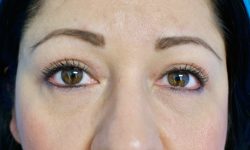 Eyelid Surgery 14 After