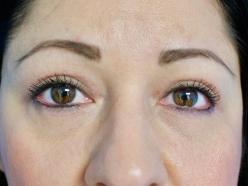 Eyelid Surgery 14 After 1