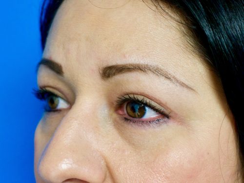 Eyelid Surgery 14 After 2