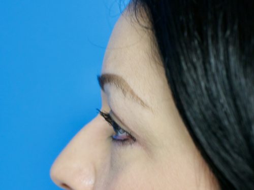 Eyelid Surgery 14 After 3