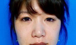 Buccal Fat Removal 05 Before