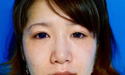 Buccal Fat Removal 05 After