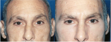 Eyelid Surgery Before and After