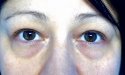 Eyelid Surgery 14 Before