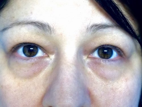 Eyelid Surgery 14 Before 1