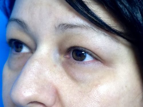 Eyelid Surgery 14 Before 2