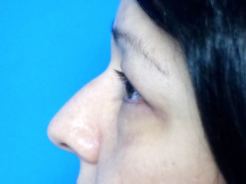 Eyelid Surgery 14 Before 3