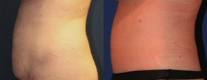 Tummy Tuck Before and After