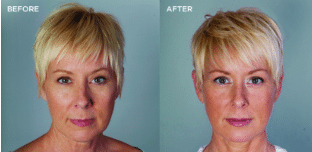 Bellafill® Before and After photo
