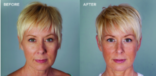 Bellafill® Before and After photo