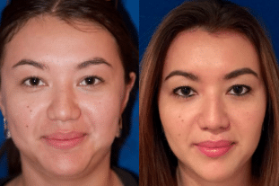 Buccal Fat Removal Patient of Dr. Taylor
