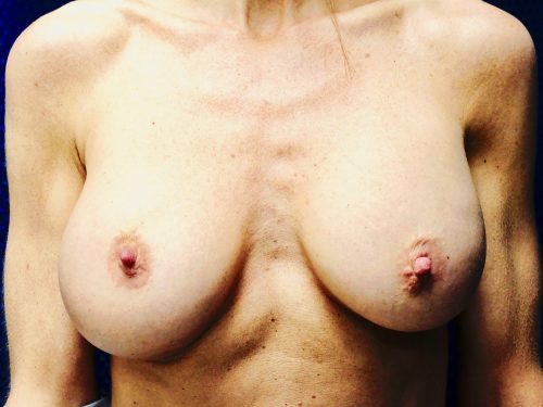 Breast Augmentation Revision 04 Before 1