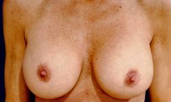 Breast Augmentation Revision 04 After