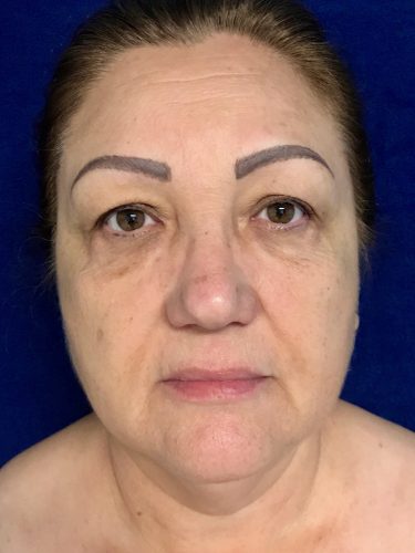 Neck Lift 05 Before 1