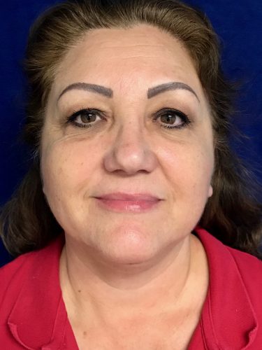 Neck Lift 05 After 1