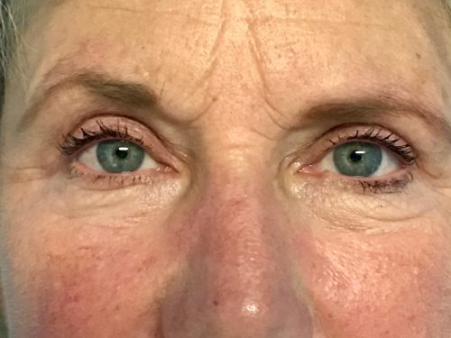 Eyelid Surgery 15 After 2