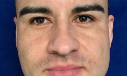 Buccal Fat Removal 07 Before