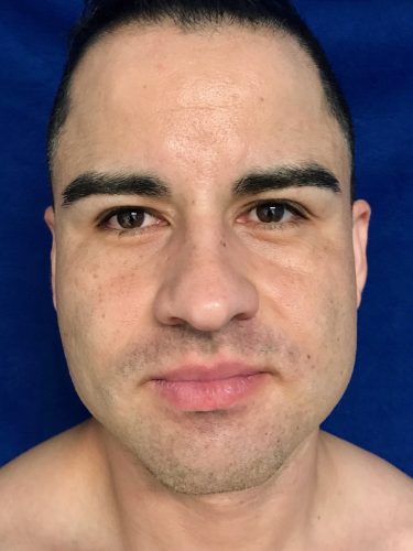 Buccal Fat Removal 07 Before 1