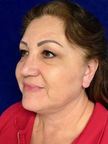 Neck Lift 05 After 2