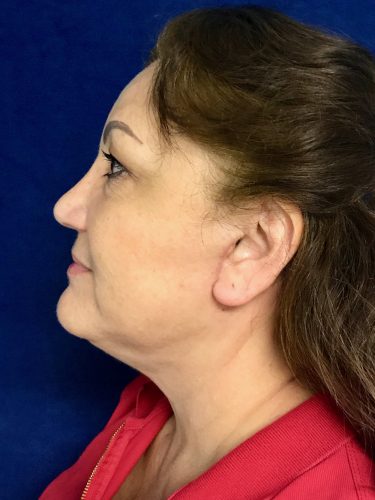 Neck Lift 05 After 3