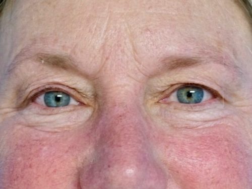 Eyelid Surgery 15 Before 2