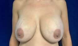 Breast Implant Exchange 04 Before