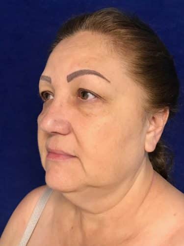 Neck Lift 05 Before 2