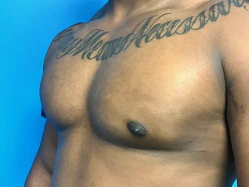 Gynecomastia 03 After 1
