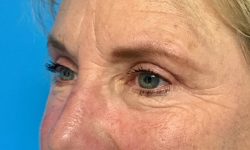 Eyelid Surgery 15 After