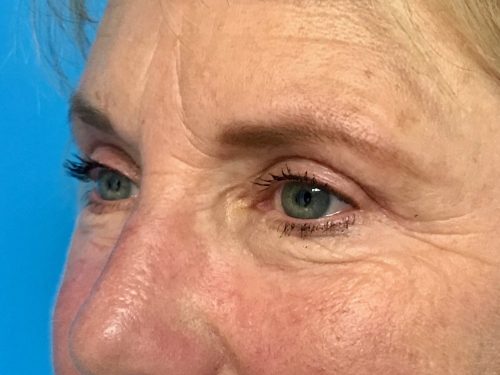 Eyelid Surgery 15 After 1