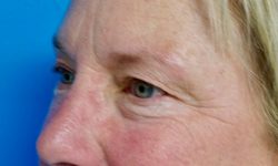 Eyelid Surgery 15 Before