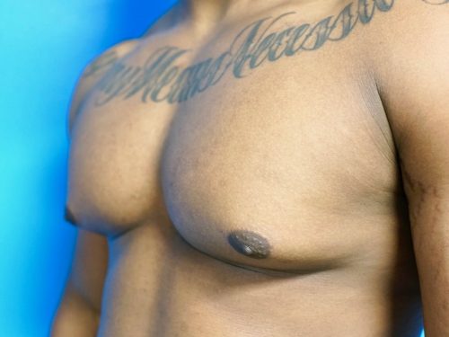 Gynecomastia 03 Before 1