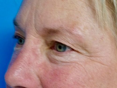 Eyelid Surgery 15 Before 1