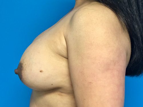 Breast Implant Exchange 02 After 3