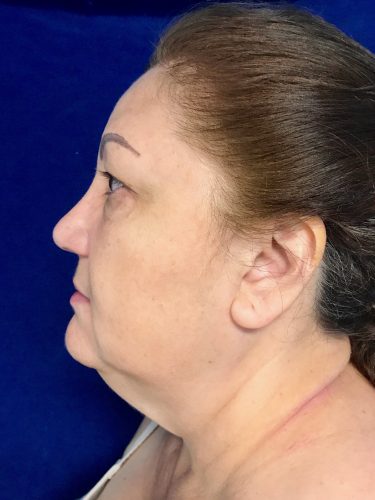 Neck Lift 05 Before 3