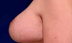 Breast Lift 07 After
