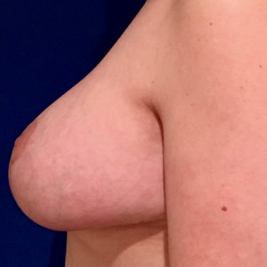 Breast Lift 07 After 1