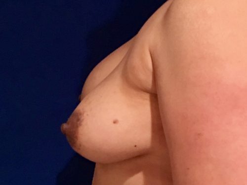 Breast Implant Exchange 02 Before 3