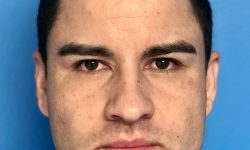 Buccal Fat Removal 07 After