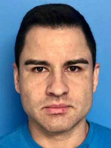 Buccal Fat Removal 07 After 1