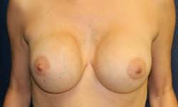 Breast Implant Exchange 03 Before