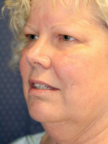 Liposuction 08 Before 2