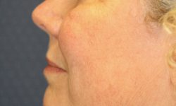 Liposuction 08 Before