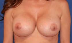 Breast Implant Exchange 03 After