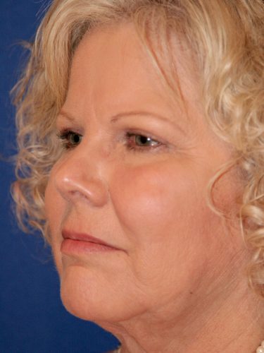 Liposuction 08 After 2