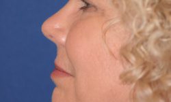 Liposuction 08 After