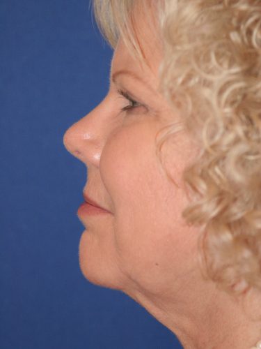 Liposuction 08 After 1