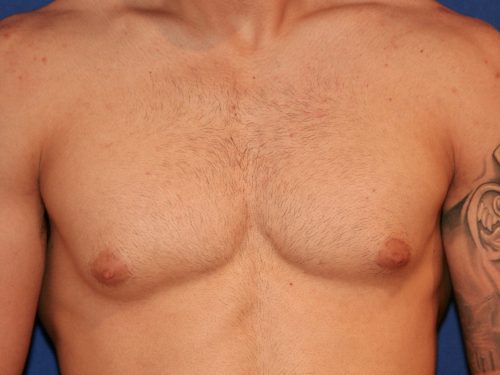 Gynecomastia 02 Before 1