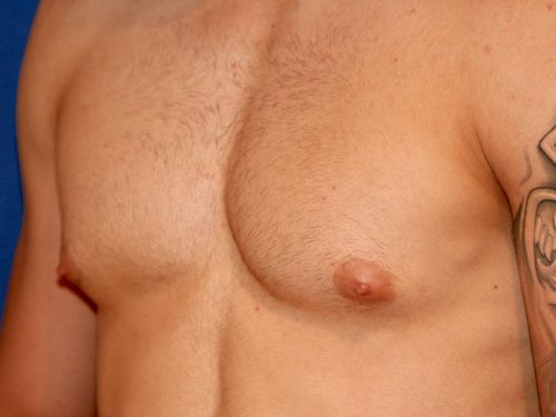Gynecomastia 02 Before 2